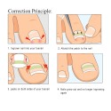 120Pcs Ingrown Toenail Straightening Clip Ingrown Toenail Correction Elastic Patches Paronychia Acronyx Correction Patch Foot Ca